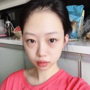 溫州蒼南人民醫(yī)院整形外科做了激光祛眼袋，讓我變得更加明媚動(dòng)人