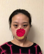 廣州瑞麗詩醫(yī)院是不是正規(guī)的？雙眼皮案例分享