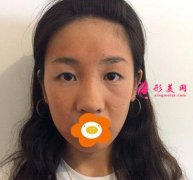 北京八大處隆鼻+雙眼皮案例分享，術(shù)后效果驚艷！