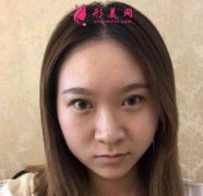 上海九院隆鼻案例真實(shí)反饋，一覽戴傳昌醫(yī)生技術(shù)！
