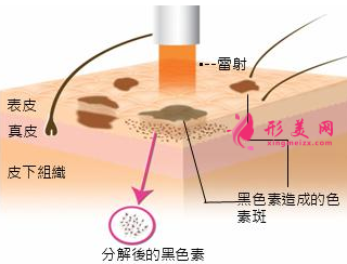 激光祛斑多少天可以洗臉