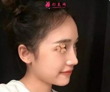 深圳福華整形醫(yī)院做的超體隆鼻效果圖，本人很喜歡！