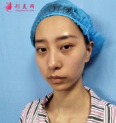 株洲中心醫(yī)院整形科去眼袋案例前后對比圖和手術(shù)經(jīng)驗分享