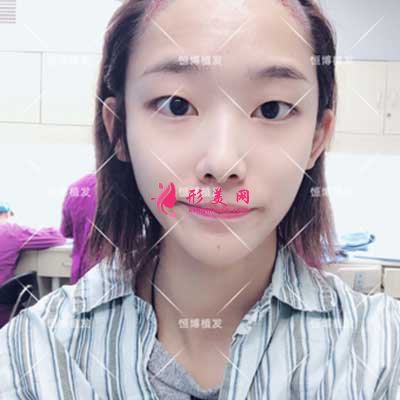 成都恒博植發(fā)術前圖片