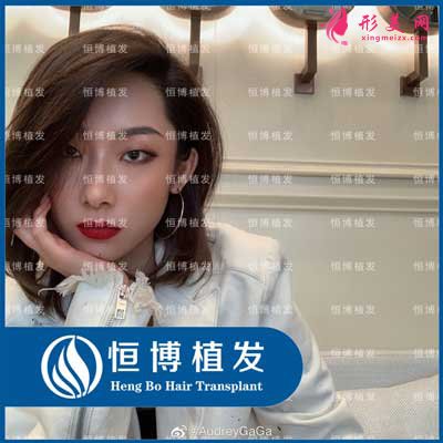 成都恒博植發(fā)術后18天圖片