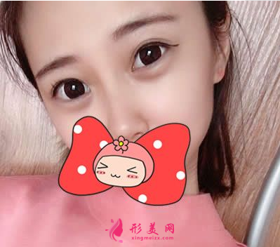 找武漢協(xié)和郭能強(qiáng)做的雙眼皮 術(shù)后60天效果真的超乎我的想象