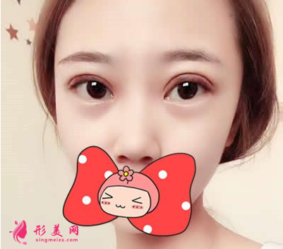 找武漢協(xié)和郭能強(qiáng)做的雙眼皮 術(shù)后60天效果真的超乎我的想象