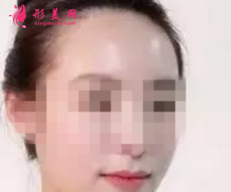 自體脂肪填充臉部要注射多少次