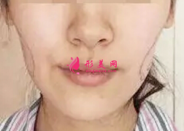 自體脂肪填充臉部要多久恢復(fù)自然
