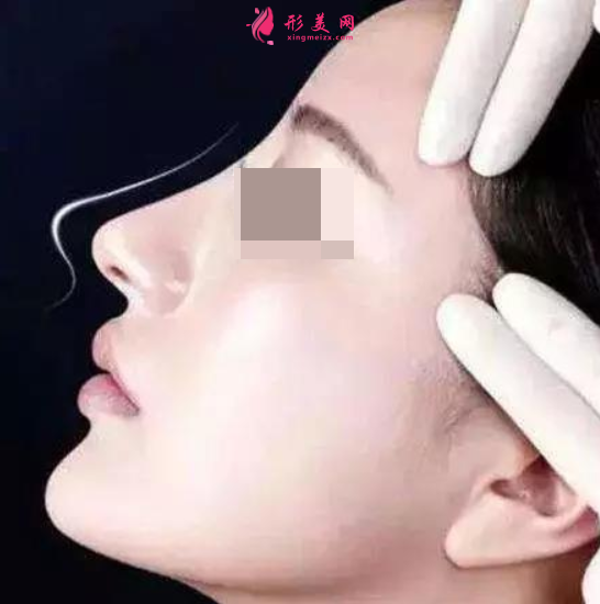 假體隆鼻哪里做得比較好