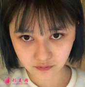 北京八大處靳小雷雙眼皮效果怎么樣？專家案例展示實(shí)力！