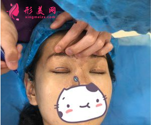 南京連天美吳應凱做雙眼皮怎么樣？90天前后對比圖案例分享