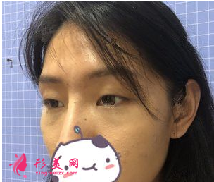 南京連天美吳應凱做雙眼皮怎么樣？90天前后對比圖案例分享