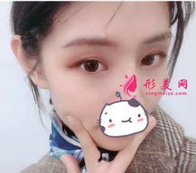南京連天美吳應凱做雙眼皮怎么樣？90天前后對比圖案例分享