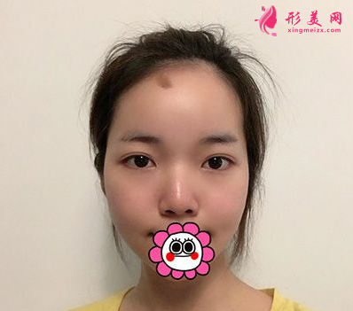 杭州藝星整形樸正馨做雙眼皮手術(shù)怎么樣？60天前后對(duì)比圖案例分享