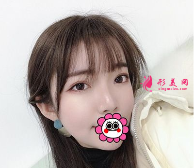 杭州藝星整形樸正馨做雙眼皮手術(shù)怎么樣？60天前后對(duì)比圖案例分享