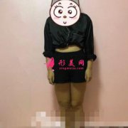 在上海第九人民醫(yī)院整形科做了大腿吸脂，輕松擺脫大象腿