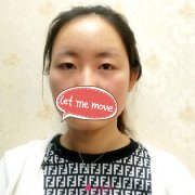 南京亞韓整形醫(yī)院眼綜合整形案例，效果比我想的還要好