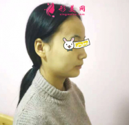 南京伊美尚整形醫(yī)院假體隆下巴案例分享，讓我更加自信美麗