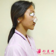 天津美萊整形醫(yī)院肋軟骨隆鼻太自然了，360度無(wú)死角