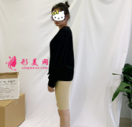 重慶美麗通整形醫(yī)院大腿吸脂效果太贊了，真的瘦了八厘米