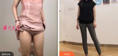 北京大學深圳醫(yī)院整形科吸脂瘦大腿咋樣?