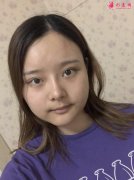 北京大學深圳醫(yī)院整形外科做下頜角貴嗎?術后效果展示