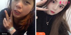 深圳美萊整形醫(yī)院隆鼻怎么樣？真實(shí)隆鼻案例效果你i了嗎？