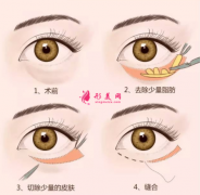 手術(shù)祛眼袋的費(fèi)用一般是多少？
