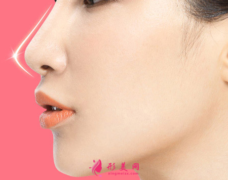 假體隆鼻怎么可以快速消腫