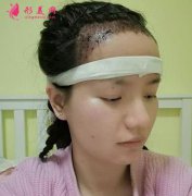 成都恒博種植發(fā)際線后，60天了恢復(fù)效果前后變化大