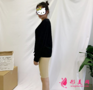 重慶軍大整形醫(yī)院大腿吸脂效果太贊了 真的瘦了八厘米