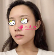 重慶時光整形醫(yī)院磨骨案例分享 輕松瘦成小V臉