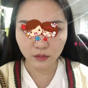 北京華韓整形醫(yī)院磨顴骨案例，讓我美美做新娘