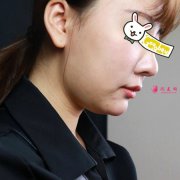 想變小V臉，就去北京純脂整形醫(yī)院-專注脂肪整形