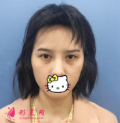 武漢施美爾整形醫(yī)院做切開雙眼皮后回頭率都高了，太美了