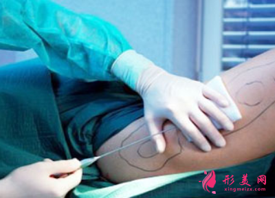 吸脂減肥出血多嗎