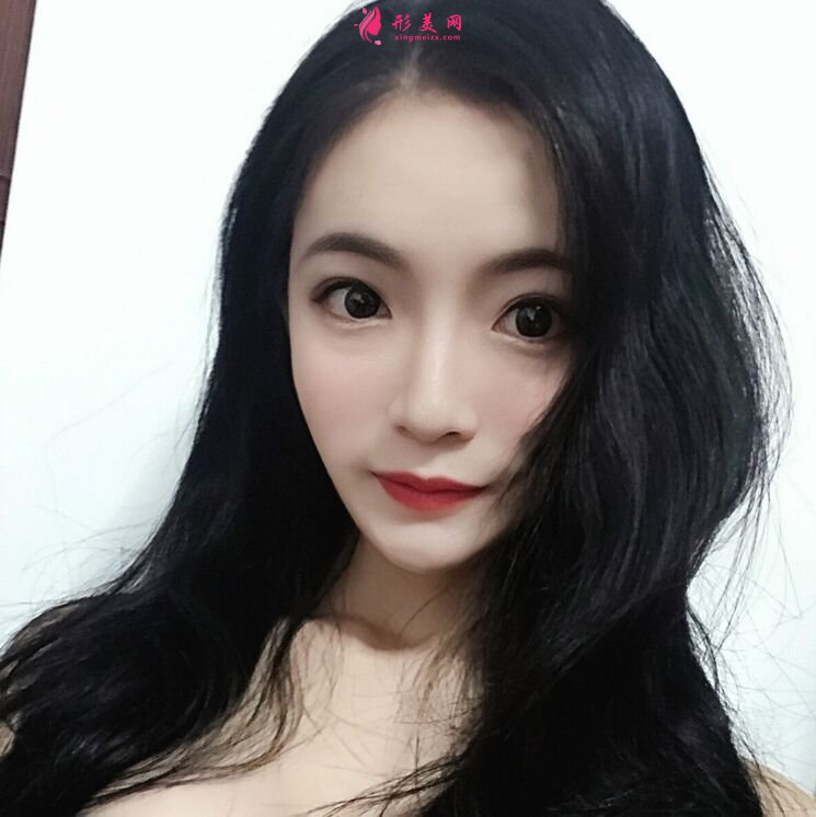 整形手術第七天