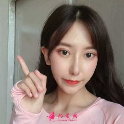 去上海華美找張明醫(yī)生做眼綜合手術(shù)后15天