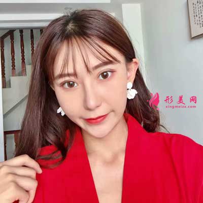 去上海華美找張明醫(yī)生做眼綜合手術(shù)后60天