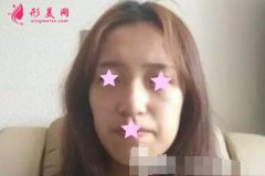 北京加減美整形怎么樣？附面部脂肪填充案例恢復效果圖