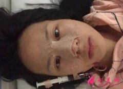 杭州維多利亞整形醫(yī)院隆鼻案例前后對比圖_附醫(yī)生介紹