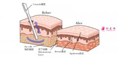 面部抽脂跟激光溶脂哪個效果好？