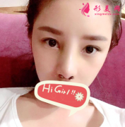 鄭州華領(lǐng)整形醫(yī)院自體軟骨隆鼻案例，側(cè)顏簡直美呆了