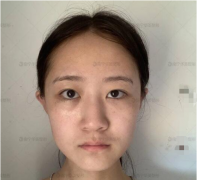 南寧華美做了個女愛豆同款鼻，沒想到效果堪比換頭?。。?></a><p class=