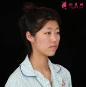 鄭州悅美整形醫(yī)院雙眼皮怎么樣？附30天恢復(fù)真實案例分享