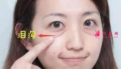 自體脂肪填充淚溝有需要特別注意的嗎?注意事項大全公開