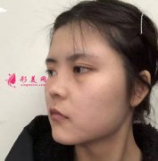 上海伯思立整形隆鼻后兩個月恢復效果分享