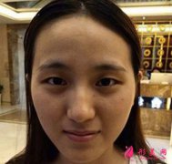 鄭州悅美整形醫(yī)院雙眼皮好嗎？小姐姐一個月恢復(fù)的逼真又迷人