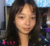 上海伊萊美整形醫(yī)院雙眼皮案例及真實成交價格在線分享